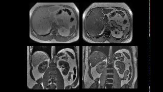 adenoma adrenal avaliação pela TC [upl. by Celle]