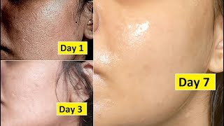 Skin Repair  Close Large OPEN PORES in 1 week Remove Dark Spots Anti Aging [upl. by Ynneg]