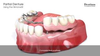 Partial denture  SlimLineSE [upl. by Adnawal]