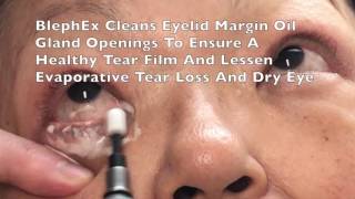 BlephEx Eyelid Treatment For Dry Eyes Blepharitis by Dr Burroughs in Colorado Springs [upl. by Rakabuba]