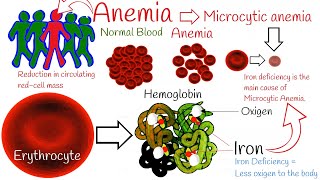 Iron deficiency anemia  Most Common anemia Microcytic anemia symptoms and treatment [upl. by Island135]