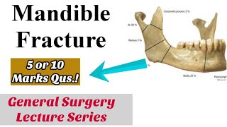 Mandibular Fracture General SurgeryOral surgery Topic Mandibular Fracture Management [upl. by Ynohtona]