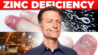 Zinc Deficiency The 7 Symptoms Youve Never Heard About [upl. by Aelyak202]