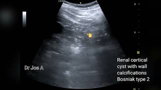 Renal cortical cyst with calcifications Bosniak type 2  ultrasound and color Doppler video [upl. by Tace]