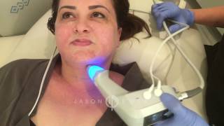 BTL Exilis Ultra  Neck Lift Skin Tightening  Cellulite Reduction  Beverly Hills [upl. by Milak]