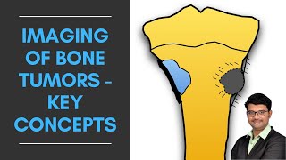 Imaging of Bone Tumors  Key Concepts  Dr Venkatesh Manchikanti ShadesofRadiology [upl. by Elocen]