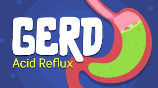 Why is your Stomach Burning  Acid Reflux  GERD Treatment and symptoms [upl. by Jo]