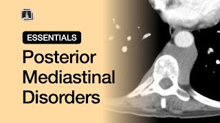 Posterior Mediastinal Disorders  Chest Radiology Essentials [upl. by Ankney585]