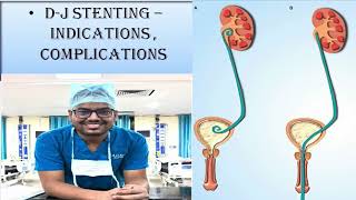 DJ STENTING  UNEDITED STEP BY STEP PROCEDURE INDICATIONS amp COMPLICATIONS [upl. by Anowahs720]