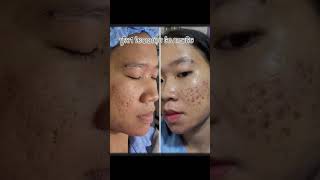 Treatment acne scars with TCA cross by Dr Theara [upl. by December348]