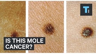 Mole Misdiagnosis When Its Really Stage IV Skin Cancer [upl. by Ecidnak]