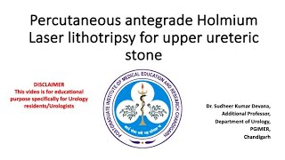 Percutaneous antegrade PCNL Holmium Laser lithotripsy of upper ureteric stone [upl. by Iahs592]