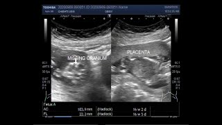 Ultrasound Video showing Anencephaly with Pregnancy of about 16 weeks 04 days [upl. by Martel]