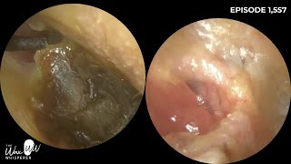 1557  Cholesteotoma AutoAtticotomy Head amp Neck of Malleus Exposed  Patient Saw Sales Assistant [upl. by Wurtz]