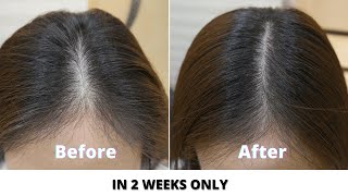 What are causes of severe hair fall like 100 strands daily  Dr Nischal K [upl. by Tabib283]