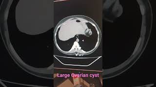 Ovarian Cyst Treatment and Laparoscopy  Dr Nilesh Chordiya [upl. by Menard]