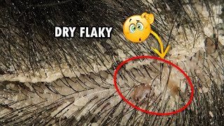 Dry Flaky Scalp Removal Dandruff Scratching Satisfying 310 [upl. by Kilmarx877]