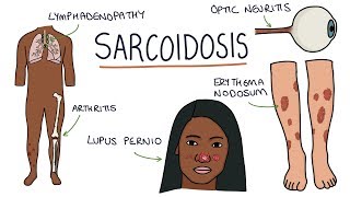 Understanding Sarcoidosis A Visual Guide for Students [upl. by Colley]