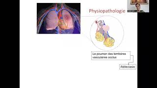 Embolie pulmonaire [upl. by Theodoric]