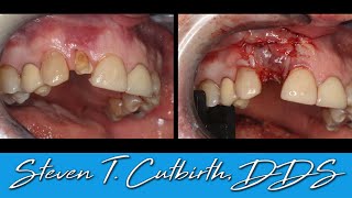 Tooth Extraction Bone Grafting PRF and Suturing  Dental Minute with Steven T Cutbirth DDS [upl. by Roldan]