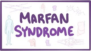 Marfan Syndrome  causes symptoms diagnosis treatment pathology [upl. by Sedruol]