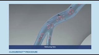 Varicose Veins Treatment ClosureFast Procedure Animation [upl. by Enneibaf]