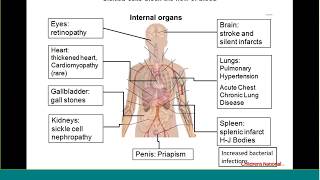 Principles of pain management and warning signs of sickle cell disease webinar [upl. by Ami718]