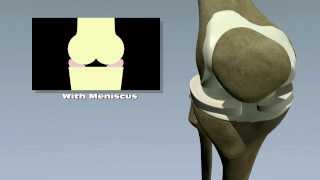 Meniscus Tears [upl. by Ayota]