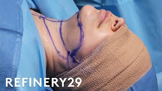 Double Chin Removal Surgery  Macro Beauty  Refinery29 [upl. by Aniloj382]