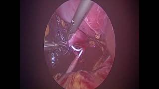 Dr Kerkeni  Laparoscopic pyeloplasty and renal cyst [upl. by Aynwad]