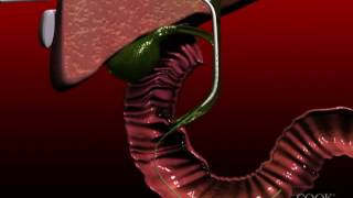 Biliary Drainage Catheter insertion animation [upl. by Thessa]