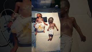 Twins  Twin Pregnancy  Babies in the womb  Multiple Pregnancy shortsfeed twins baby fyp [upl. by Lihp100]