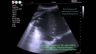 Lung ultrasound  PLAPS point with pleural effusion static and dynamic airbronchograms 19F ARDS [upl. by Casanova508]