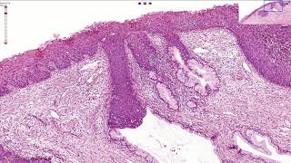 HSIL  High Grade Squamous Intraepithelial Lesion  Histopathology [upl. by Bausch]