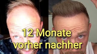 Haartransplantation Türkei 12 Monate VORHER NACHHER😨 [upl. by Terej464]