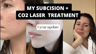 1 Year later  Subcision and ablative CO2 Laser Results [upl. by Nelie522]