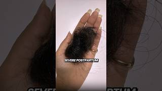 The Hair Growth Serum That Grew My Hair back hairgrowth hairfall hairfallsolution wishcare [upl. by Salot]