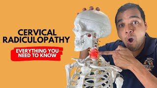 Cervical Radiculopathy Everything You Need To Know To Get Better Without Surgery [upl. by Batty]