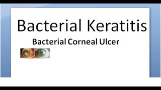 Ophthalmology 111 a Bacterial Keratitis Corneal Ulcer Cornea Bacteria Infective Hypopyon infection [upl. by Ojillek706]