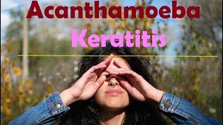 Acanthamoeba keratitis Hindi [upl. by Nivre]