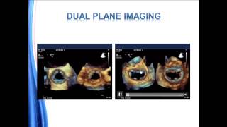 How to get the standard transthoracic echocardiography TTE views [upl. by Magda80]