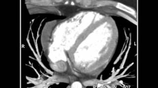 Cardiac Pericardial Cyst 2 of 2 [upl. by Ema841]