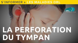 Perforation du tympan  Information patient [upl. by Dolorita]