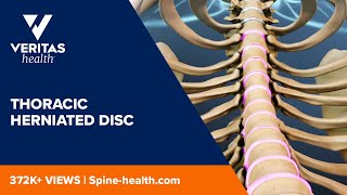 Thoracic Herniated Disc [upl. by Anaicul]