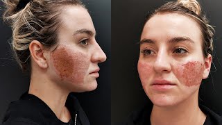 Acne Scar Removal with CO2 Laser Treatment  Before amp After [upl. by Olnton]