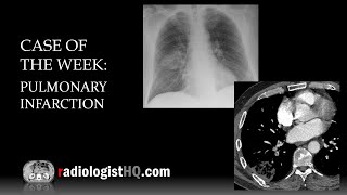 Case of the Week Pulmonary Infarction Xray amp CT [upl. by Cassidy]