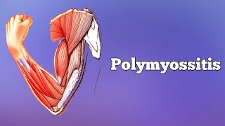 Polymyositis amp Dermatomyositis [upl. by Eittocs]