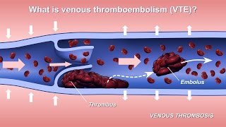 Understanding and Diagnosing Venous Thromboembolism VTE [upl. by Sherburne]