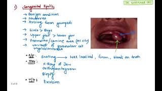 Epulis  Types Clinical Features Treatment  Surgery  Dr Shankar Dey [upl. by Ynned]