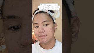 Just trust the process 😍😍 acnejourney skincare acne [upl. by Corbie]